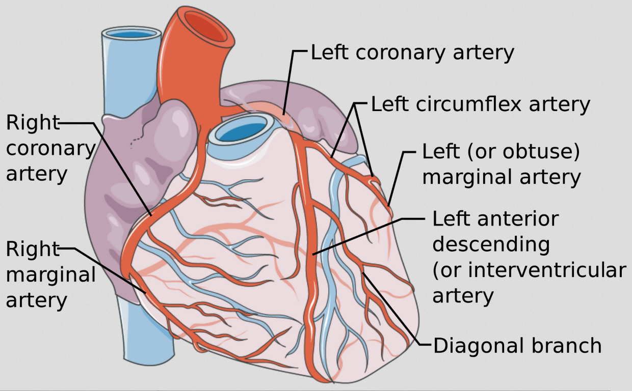 CABG diagram from reputable medical source