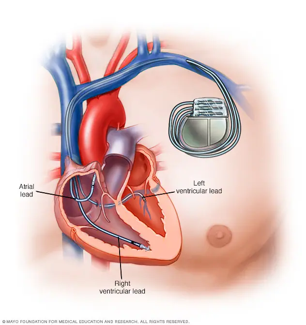 Pacemaker insertion diagram