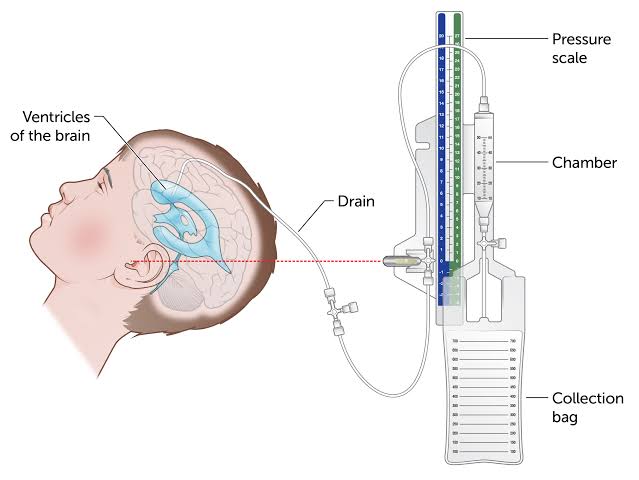 EVD anatomy